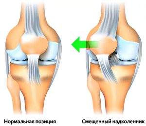 смещенный надколенник